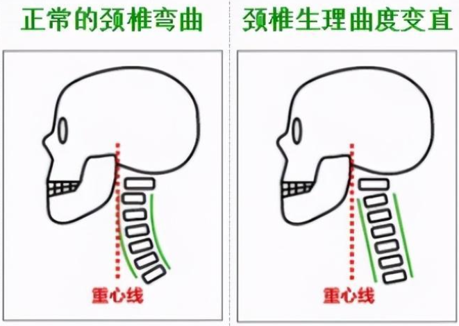 颈椎生理曲度变直鉴别及纠正_颈椎生理曲度变直怎么办？