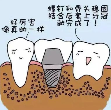 种植牙的五大危害